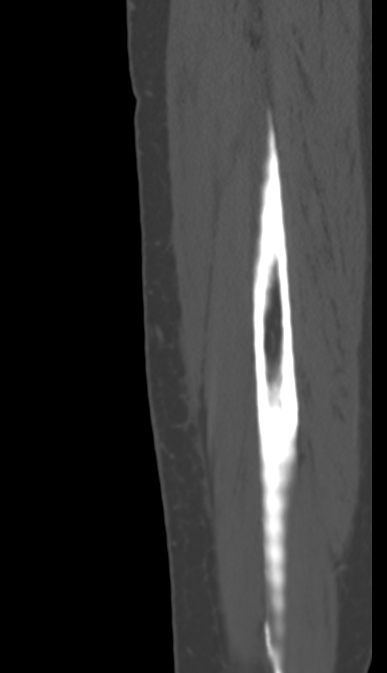 Bone metastasis - tibia (Radiopaedia 57665-64609 Sagittal bone window 168).jpg