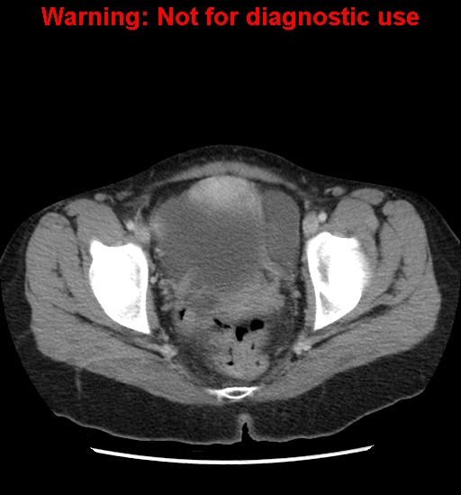 Borderline mucinous cystadenoma of ovary (Radiopaedia 25586-25767 A 105).jpg