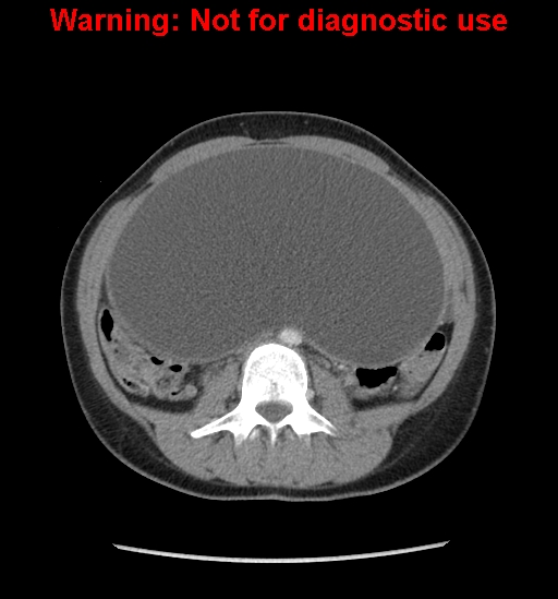 Borderline mucinous cystadenoma of ovary (Radiopaedia 25586-25767 A 31).jpg