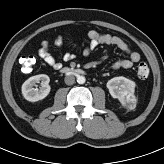 File:Bosniak cyst - type IV (Radiopaedia 23525-23627 renal cortical phase 35).jpg