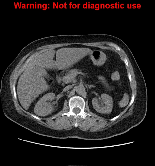 File:Bosniak renal cyst - type II (Radiopaedia 23404-23468 Axial non-contrast 9).jpg