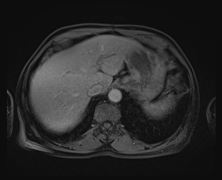 Bouveret syndrome (Radiopaedia 61017-68856 Axial T1 C+ fat sat 16).jpg
