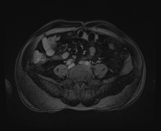 Bouveret syndrome (Radiopaedia 61017-68856 Axial T1 C+ fat sat 70).jpg