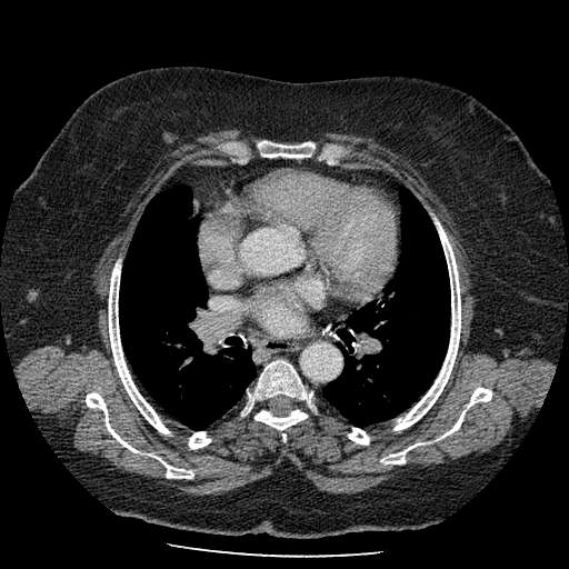 Bovine aortic arch - right internal mammary vein drains into the superior vena cava (Radiopaedia 63296-71875 A 76).jpg