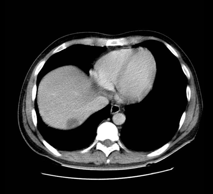 Bowel obstruction from colon carcinoma (Radiopaedia 22995-23028 A 7).jpg