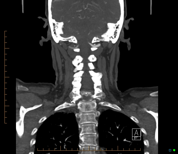 Brachiocephalic trunk stenosis (Radiopaedia 87242-103519 B 51).jpg