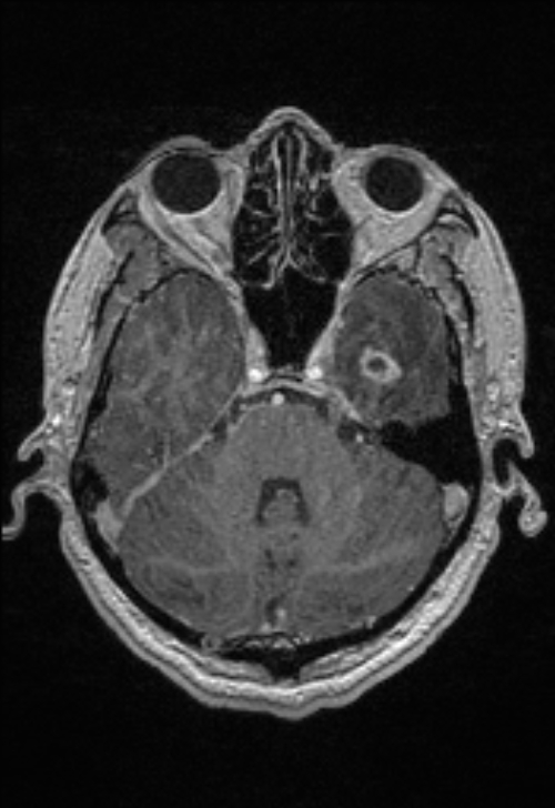 Brain abscess with ventriculitis (Radiopaedia 85703-101495 Axial T1 C+ 55).jpg