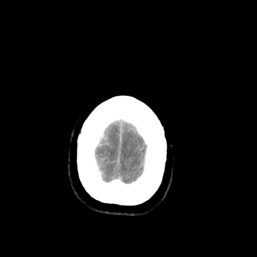 File:Brain contusions, internal carotid artery dissection and base of skull fracture (Radiopaedia 34089-35339 Axial non-contrast 42).png