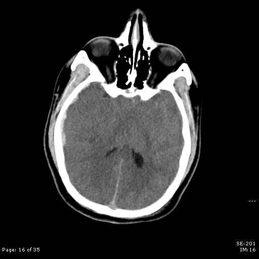 File:Brain death after motor vehicle collision (Radiopaedia 88470-105114 Axial non-contrast 16).jpg