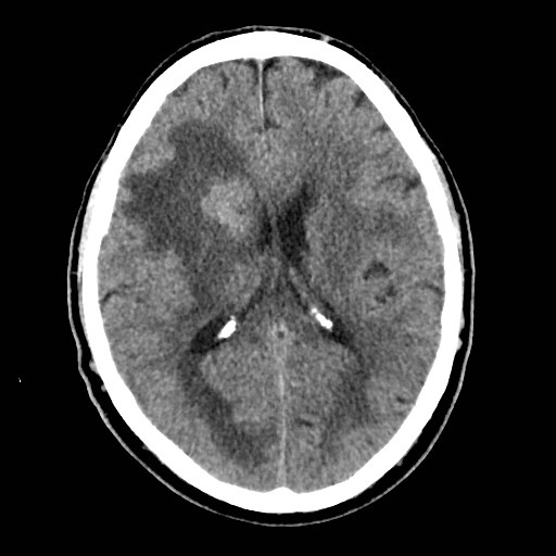 File:Brain metastases from lung cancer (Radiopaedia 83839-99027 Axial non-contrast 20).jpg