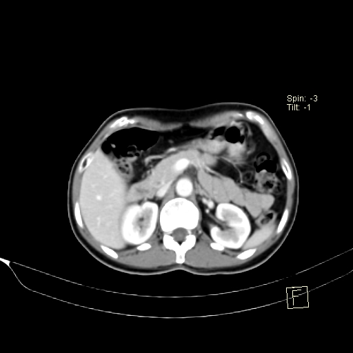 Brain metastasis as initial presentation of non-small cell lung cancer (Radiopaedia 65122-74127 A 56).jpg