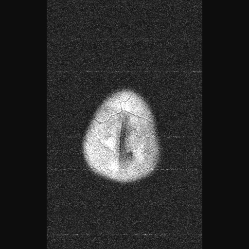 File:Brainstem ganglioglioma (Radiopaedia 10763-11224 Axial FLAIR 1).jpg