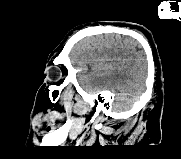 Brainstem hemorrhage (Radiopaedia 81294-94976 C 12).jpg