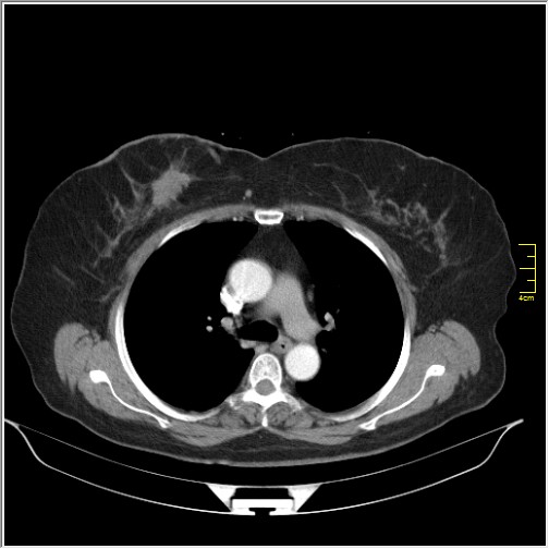 File:Breast cancer on thorax CT (Radiopaedia 60571-68275 A 37).JPG