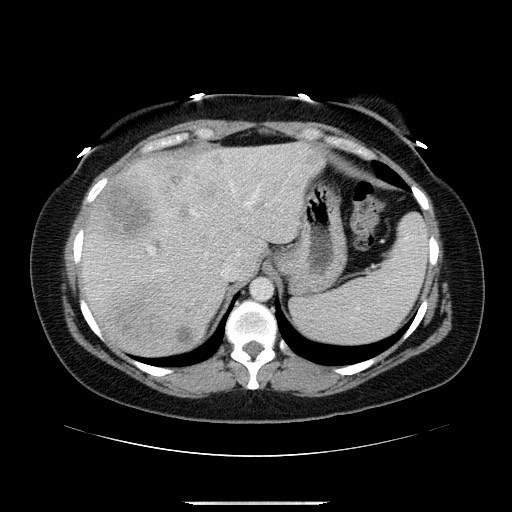 File:Breast cancer pseudocirrhosis after chemotherapy (Radiopaedia 65407-74456 A 19).jpg