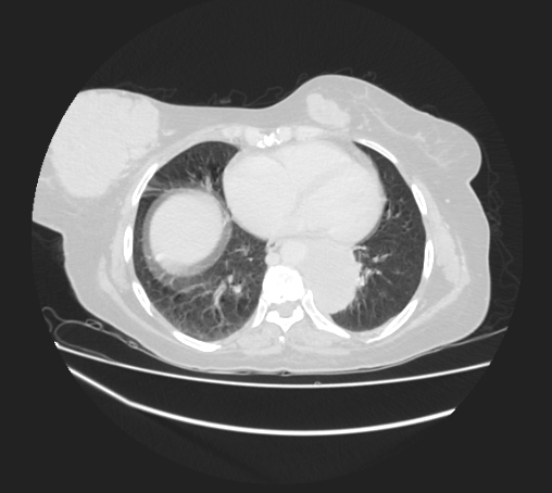 Breast metastases from facial malignant melanoma (Radiopaedia 60316-67975 Axial lung window 75).jpg