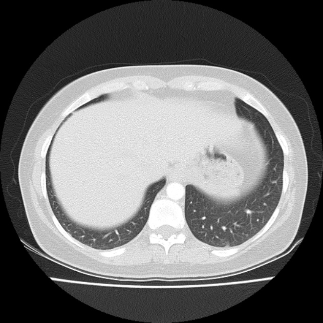 Bronchial atresia (Radiopaedia 22965-22992 Axial lung window 11).jpg