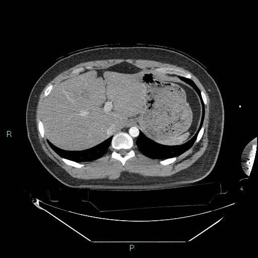 Bronchial carcinoid tumor (Radiopaedia 78272-90870 B 109).jpg
