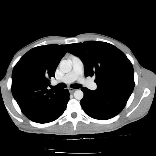 Bronchial carcinoid tumor causing right lower lobe collapse (Radiopaedia 83495-98594 A 21).jpg