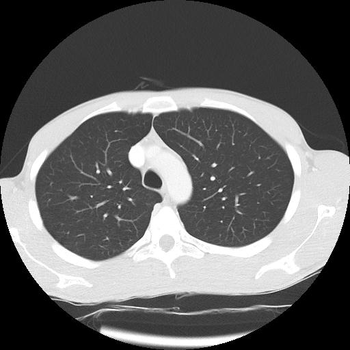 Bronchial carcinoid tumor causing right lower lobe collapse (Radiopaedia 83495-98594 Axial lung window 12).jpg