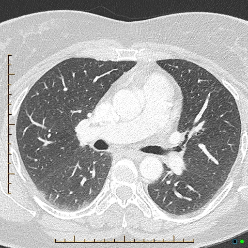 File:Bronchial diverticula (Radiopaedia 79512-92676 Axial lung window 84).jpg