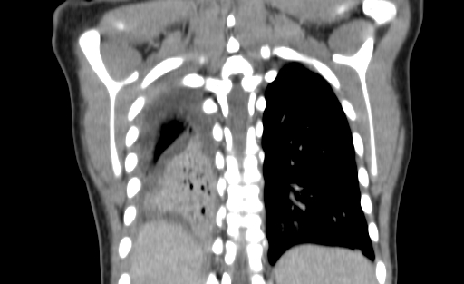 Bronchial mucoepidermoid carcinoma (Radiopaedia 57023-63895 Coronal 108).jpg