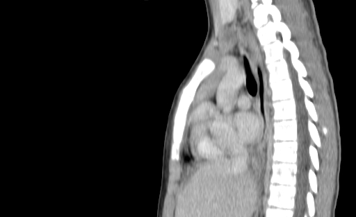 Bronchial mucoepidermoid carcinoma (Radiopaedia 57023-63895 Sagittal 118).jpg