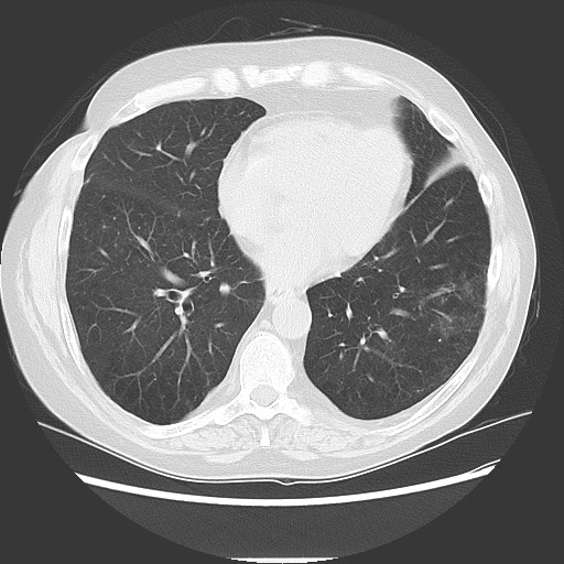 Bronchial stenosis - lung transplant (Radiopaedia 73133-83848 Axial lung window 42).jpg
