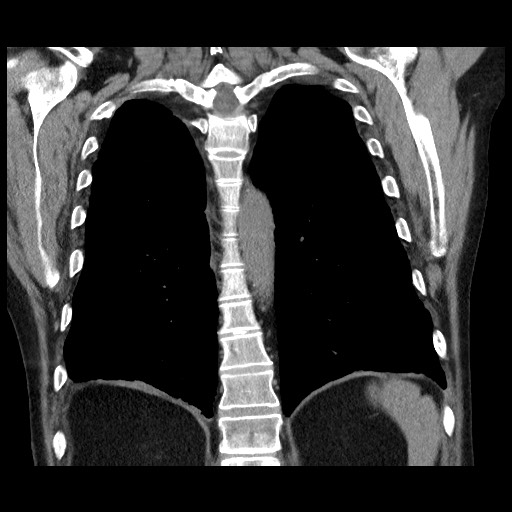 Bronchial stenosis - lung transplant (Radiopaedia 73133-83848 Coronal non-contrast 47).jpg