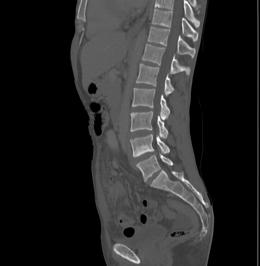 File:Bronchiectasis in Crohn disease (Radiopaedia 60311-67977 Sagittal bone window 131).jpg
