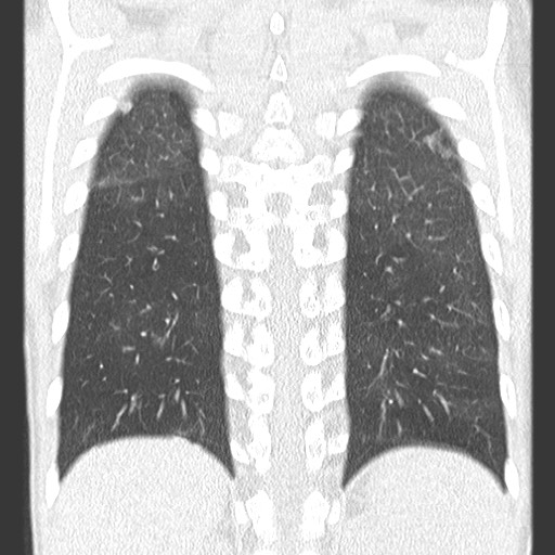 File:Bronchiolotis obliterans (Radiopaedia 73769-84575 Coronal lung window 31).jpg