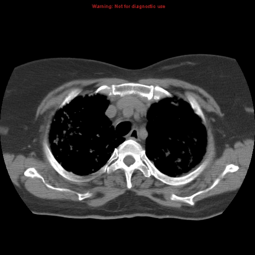 Bronchoalveolar carcinoma (Radiopaedia 13224-13233 Axial non-contrast 12).jpg