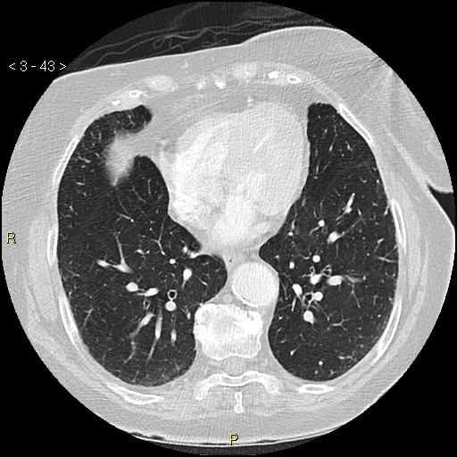 Bronchogenic carcinoma as an incidental finding (Radiopaedia 16453-16130 Axial lung window 43).jpg