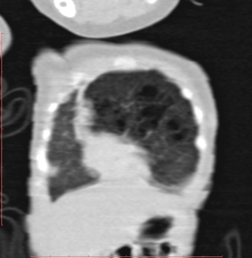 Bronchogenic cyst (Radiopaedia 78599-91409 Coronal lung window 38).jpg