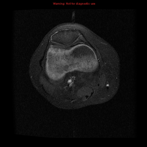 File:Brown tumor (Radiopaedia 12318-12597 Axial T1 C+ fat sat 6).jpg