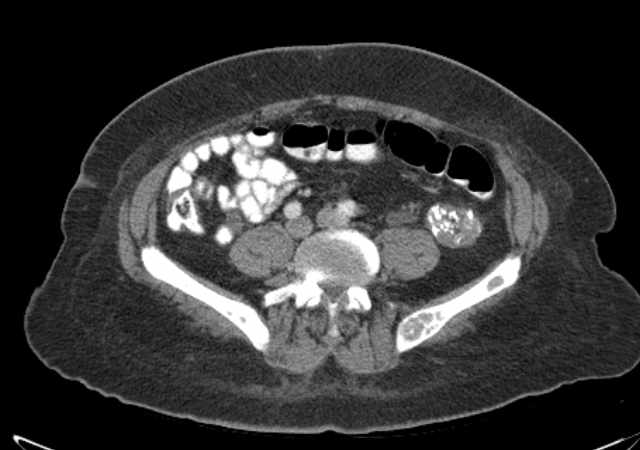 File:Brown tumors compressing the spinal cord (Radiopaedia 68442-77988 E 82).jpg
