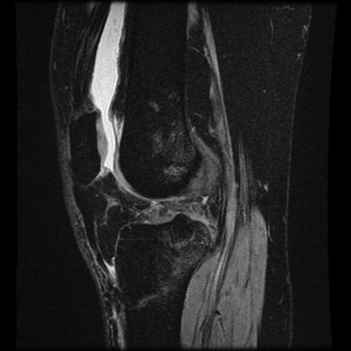 Bucket handle meniscus tear (Radiopaedia 56916-63751 H 36).jpg