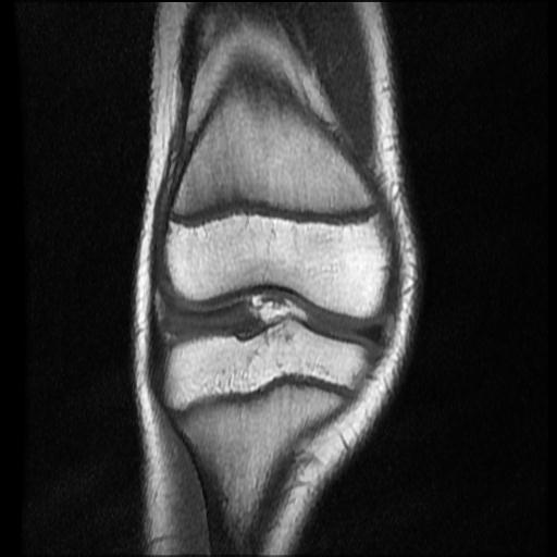 File:Bucket handle tear - lateral meniscus (Radiopaedia 72124-82634 Coronal T1 6).jpg