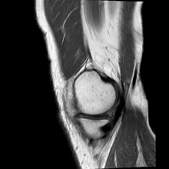 File:Bucket handle tear - medial meniscus (Radiopaedia 29250-29664 Sagittal PD 19).jpg