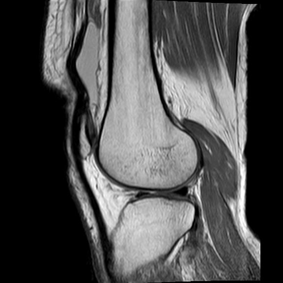 File:Bucket handle tear - medial meniscus (Radiopaedia 29250-29664 Sagittal PD 6).jpg