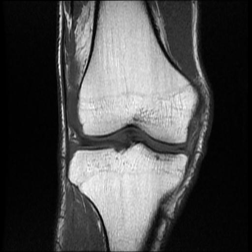 File:Bucket handle tear - medial meniscus (Radiopaedia 69245-79026 Coronal T1 9).jpg