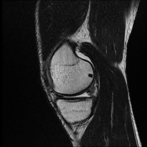 File:Bucket handle tear - medial meniscus (Radiopaedia 69245-79026 Sagittal T2 16).jpg