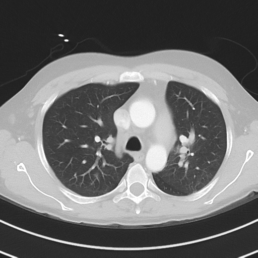 Burkitt lymphoma (Radiopaedia 34686-36121 Axial lung window 18).png