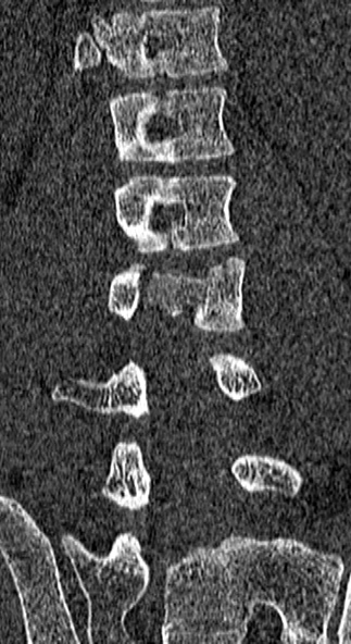 File:Burst fracture (Radiopaedia 53373-59357 Coronal bone window 43).jpg