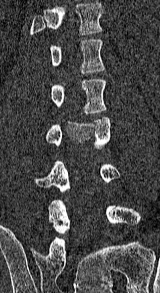 Burst fracture (Radiopaedia 53373-59357 Coronal bone window 45).jpg