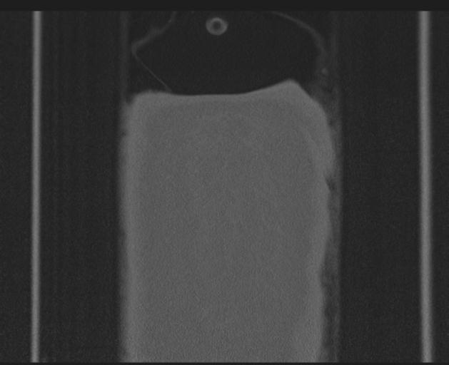 Burst fracture - thoracic spine (Radiopaedia 30238-30865 Coronal bone window 165).jpg