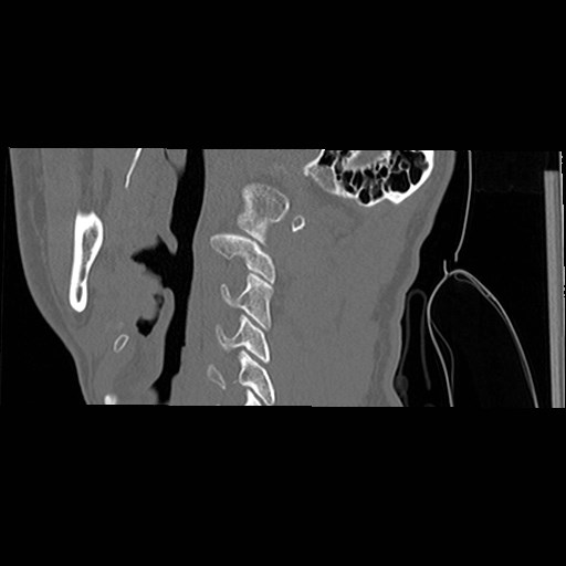 File:C1-C2 "subluxation" - normal cervical anatomy at maximum head rotation (Radiopaedia 42483-45607 C 51).jpg
