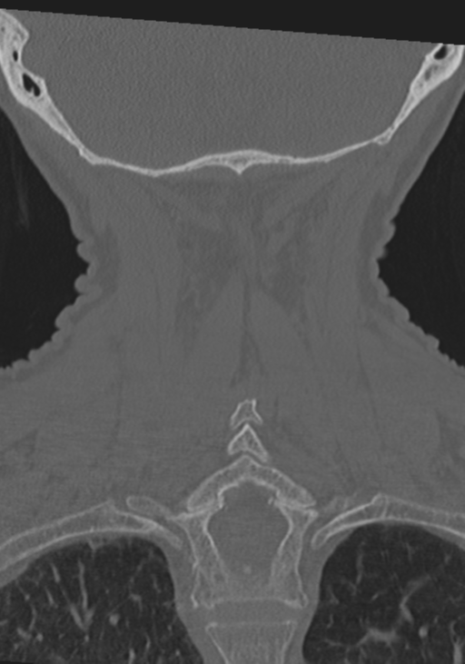 C2 fracture with vertebral artery dissection (Radiopaedia 37378-39199 Coronal bone window 42).png