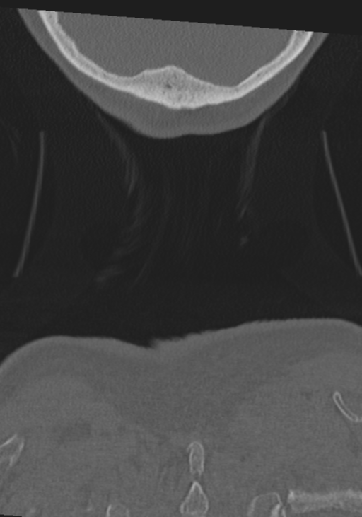 C2 fracture with vertebral artery dissection (Radiopaedia 37378-39199 Coronal bone window 69).png