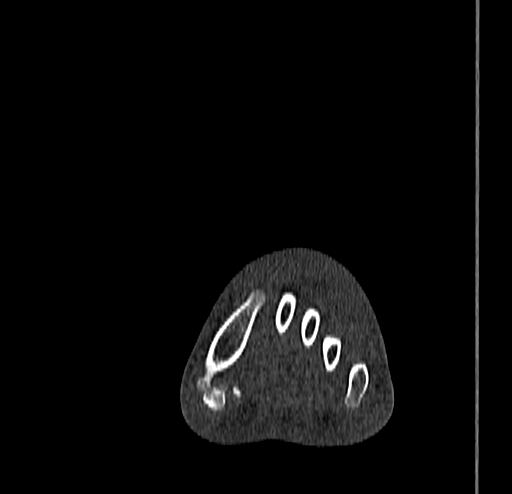 Calcaneal fracture - Sanders type 4 (Radiopaedia 90179-107370 Coronal bone window 33).jpg